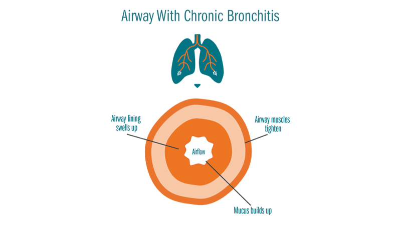 An illustration of airways with chronic bronchitis, showing the limiting of airflow