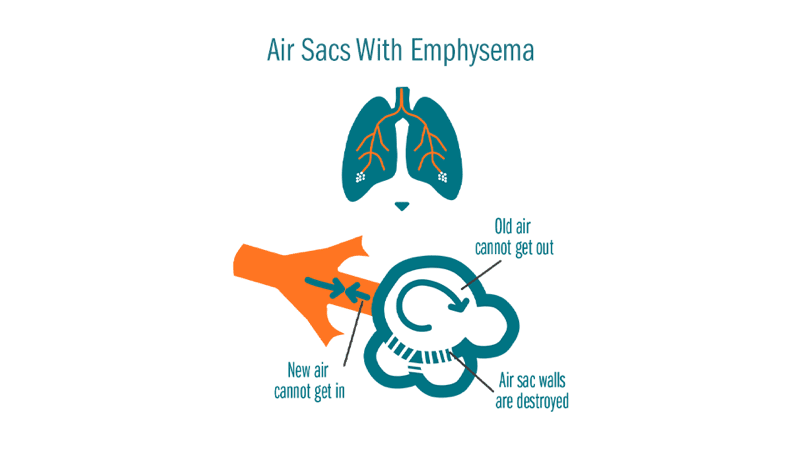 An illustration of air sacs with emphysema, showing the trapping of air